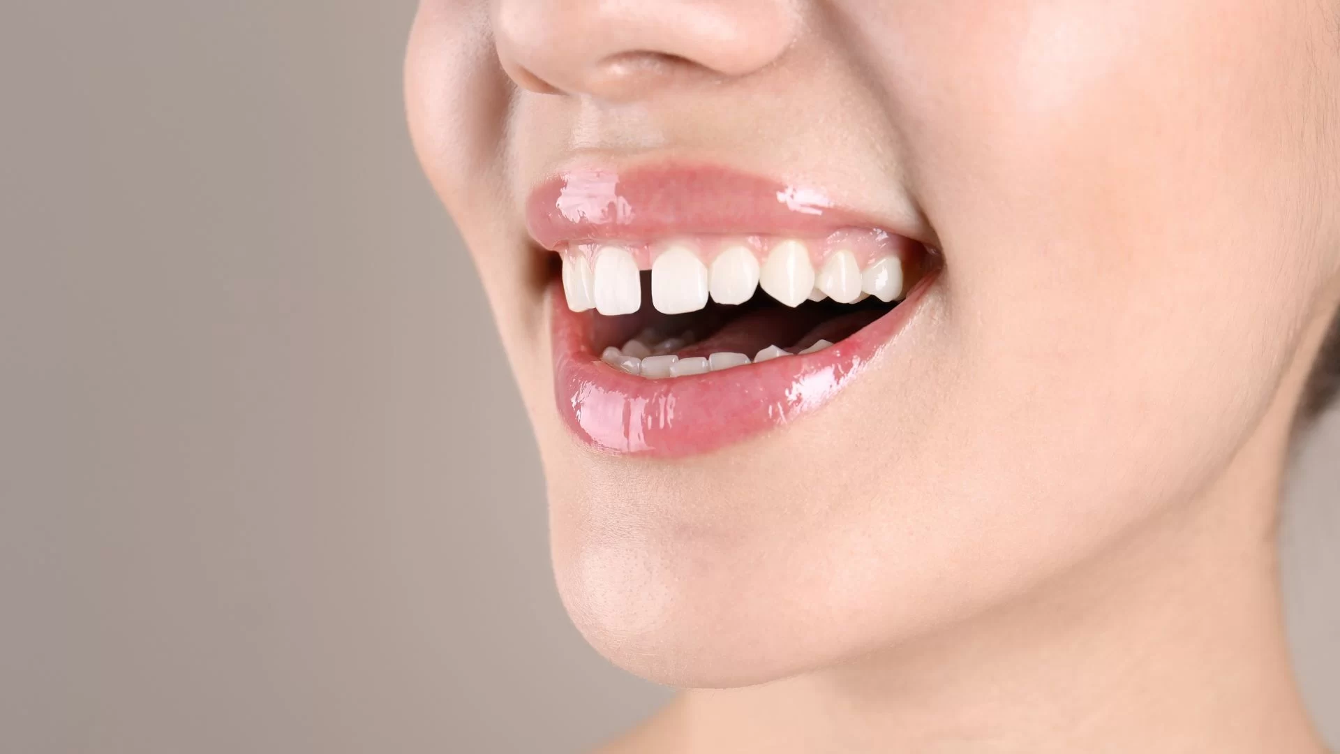 How to Get Rid of Gaps Between Teeth: A Complete Guide to Closing Gaps