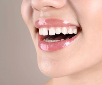 How to Get Rid of Gaps Between Teeth: A Complete Guide to Closing Gaps