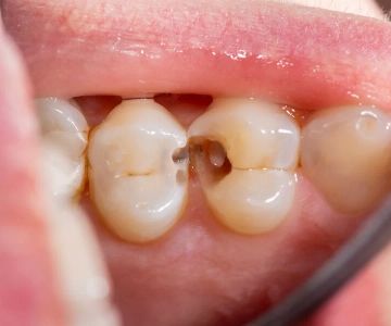 Causes of Cavities in Baby Teeth and How to Treat Them Effectively