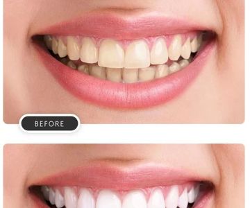 What Causes Tooth Discoloration and How to Treat It: Your Complete Guide to Whitening Solutions
