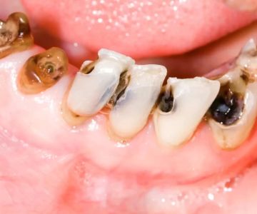 Tooth Decay and the Importance of Early Detection for Better Oral Health