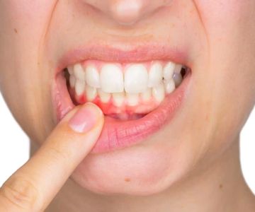 How to Prevent Gingivitis with Healthy Oral Care Habits | Essential Tips for Better Oral Health