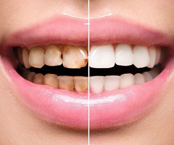 How to Reverse Gum Disease Before It Gets Serious: Early Treatment and Prevention