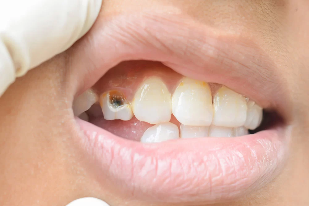 How to Recognize Tooth Decay in Its Early Stages: Key Signs to Watch For