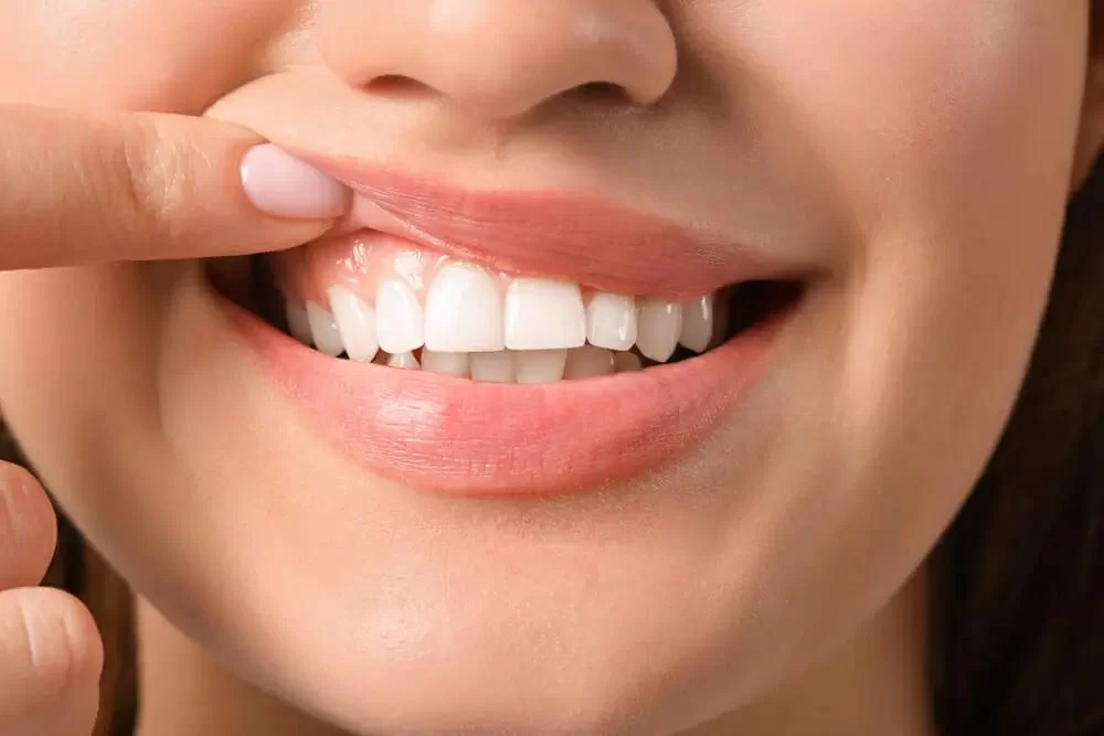Best Oral Habits to Follow for Avoiding Gingivitis and Maintaining Healthy Gums