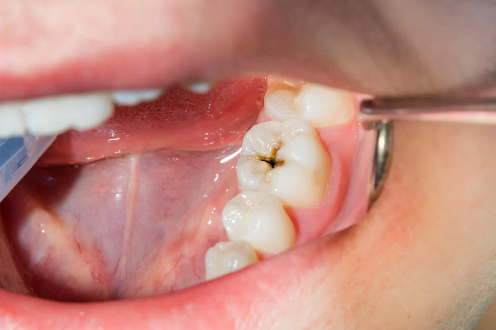 Best Ways to Prevent Cavities at Home