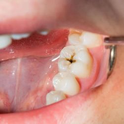 Best Ways to Prevent Cavities at Home
