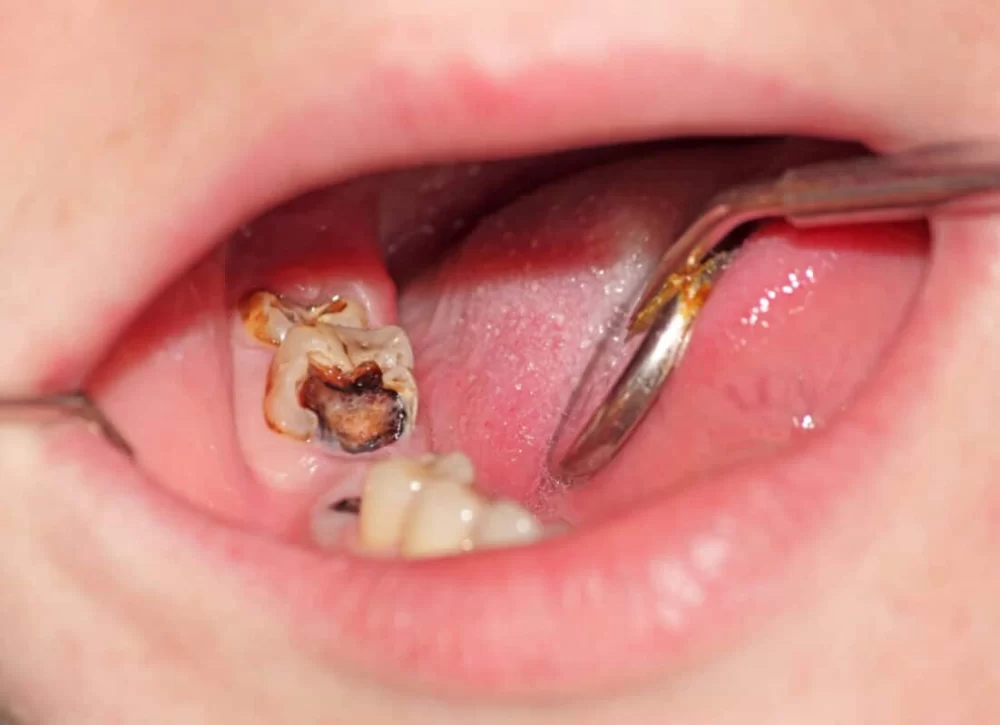 How Untreated Tooth Decay Leads to Tooth Loss