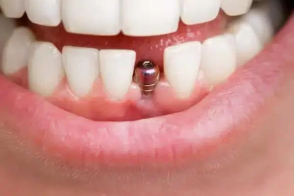 How Long Do Dental Implants Last With Proper Care?
