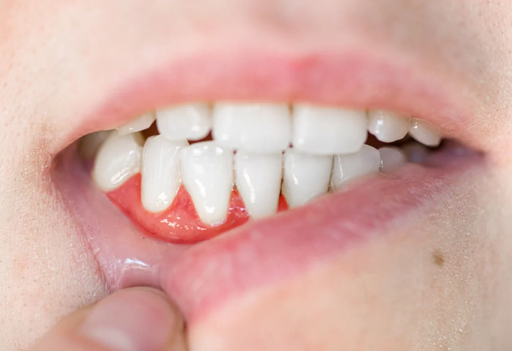 How to Effectively Treat a Tooth Abscess at Home – Essential Tips and Remedies