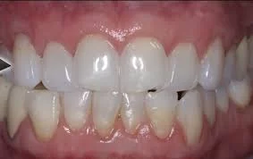 How to Treat Gum Recession Without Surgery: Effective Non-Surgical Methods