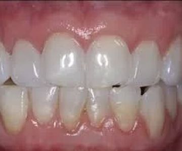How to Treat Gum Recession Without Surgery: Effective Non-Surgical Methods
