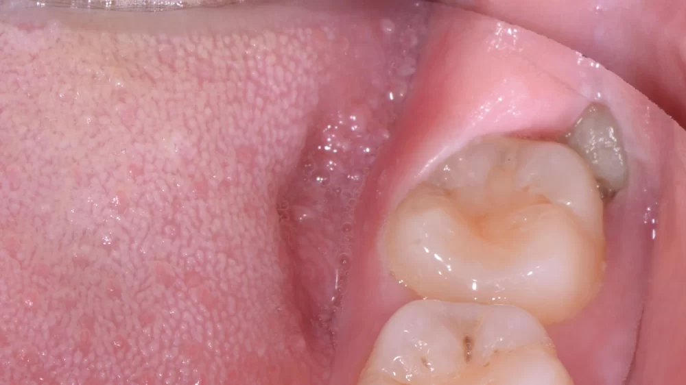 Why Do Wisdom Teeth Cause Pain? Causes and Solutions Explained