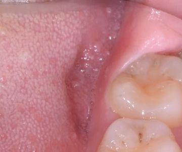 Why Do Wisdom Teeth Cause Pain? Causes and Solutions Explained
