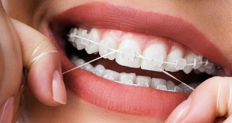 Best Flossing Technique for Braces Wearers: Expert Tips for Effective Oral Care
