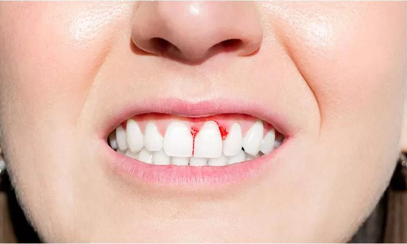 Natural Ways to Reduce Gum Bleeding: Effective Tips for Healthier Gums