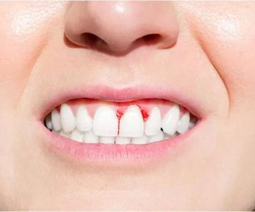 Natural Ways to Reduce Gum Bleeding: Effective Tips for Healthier Gums