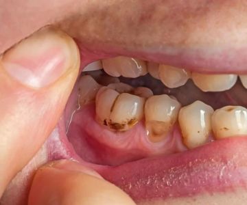 How to Treat Tooth Pain Caused by Sinus Infection: Effective Solutions