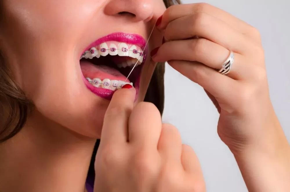 Effective Tips for Flossing with Braces to Maintain Optimal Oral Health