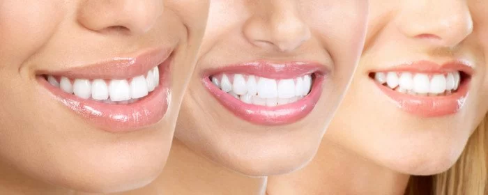 Effective Ways to Prevent Teeth from Shifting After Braces Treatment
