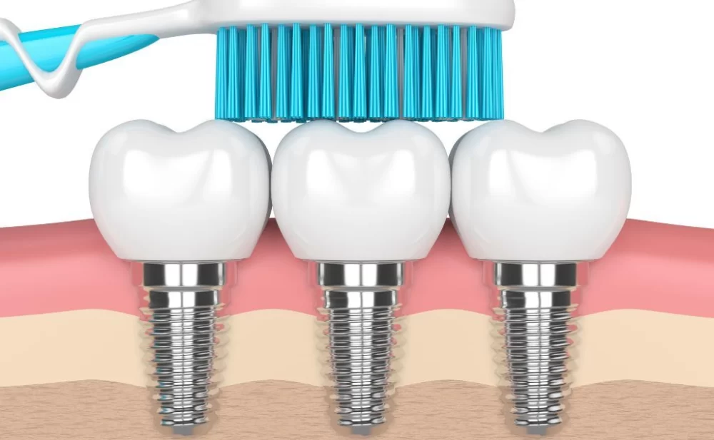 Effective Ways to Clean Dental Implants to Prevent Infection and Maintain Oral Health