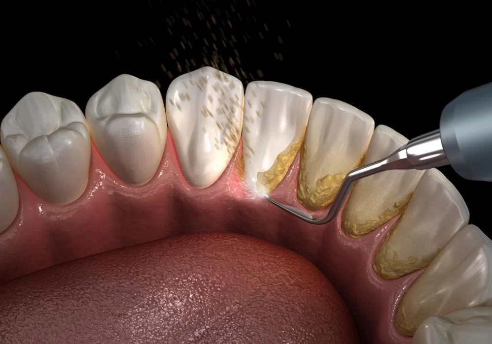 Understanding the Difference Between Plaque and Tartar: Essential Oral Health Guide