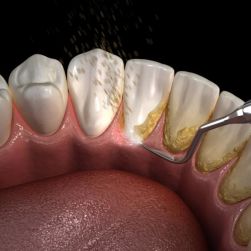 Understanding the Difference Between Plaque and Tartar: Essential Oral Health Guide