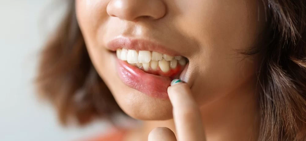 The Best Treatments for Receding Gums to Restore Your Smile