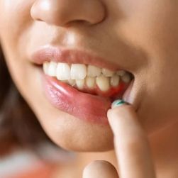 The Best Treatments for Receding Gums to Restore Your Smile