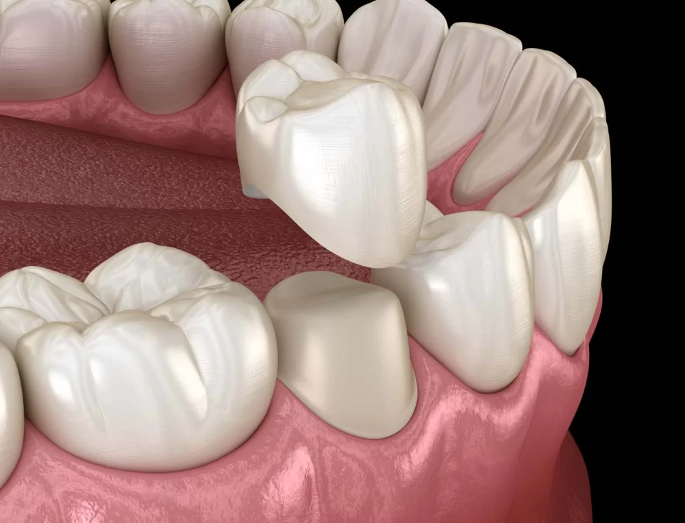 The Importance of Dental Crowns: Key Benefits and Why They're Essential for Oral Health