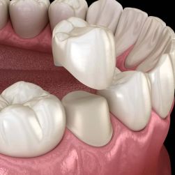 The Importance of Dental Crowns: Key Benefits and Why They're Essential for Oral Health