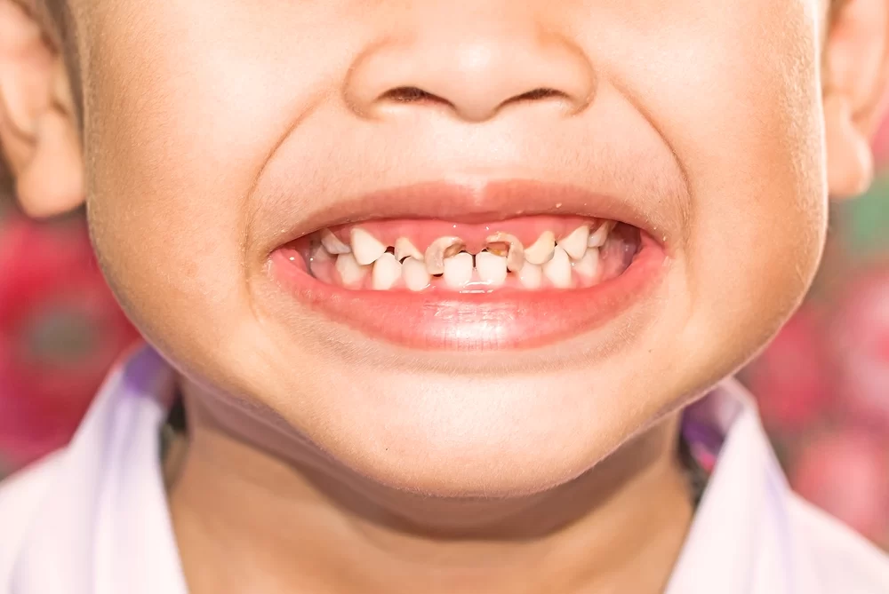 How to Prevent Tooth Decay in Infants: Expert Tips for Healthy Baby Teeth