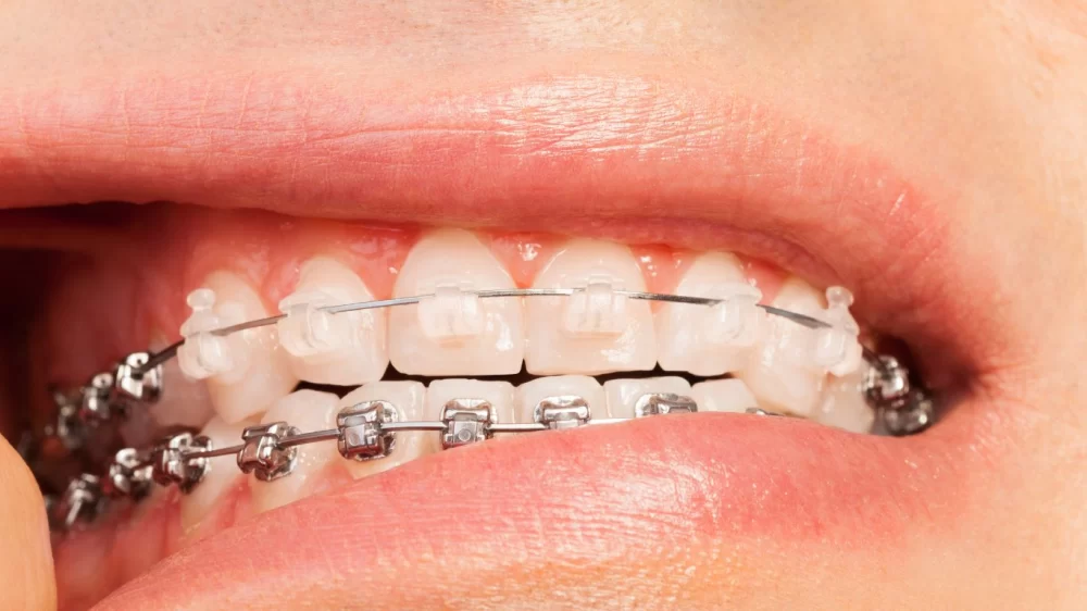 The Impact of Orthodontic Treatment on Oral Health: Benefits & Transformations