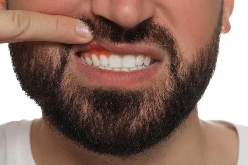 Effects of High Blood Pressure on Oral Health: How Hypertension Impacts Your Teeth and Gums