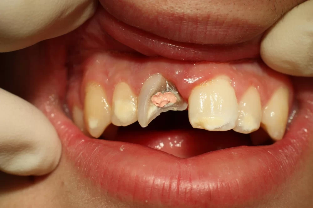 How to Treat a Toothache Caused by a Broken Tooth