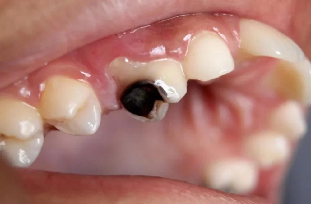 How to Prevent and Treat Cavities in Teenagers: Essential Tips for Healthy Teeth