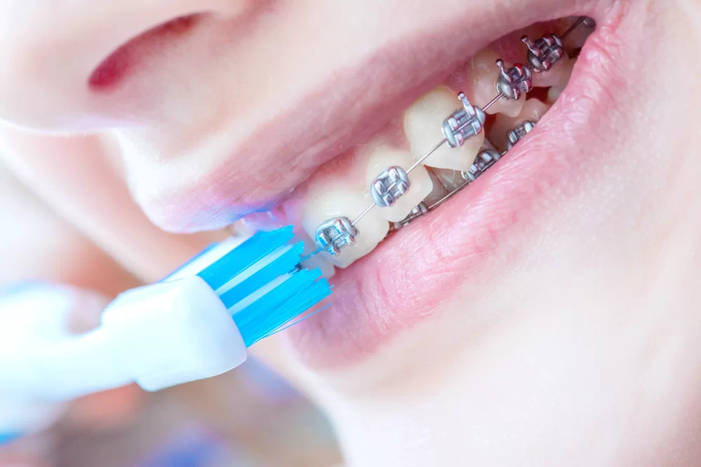 Choosing the Best Toothbrush for Sensitive Teeth and Braces: Expert Tips and Recommendations