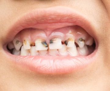 How to Treat Tooth Decay in Baby Teeth: Effective Strategies for Parents