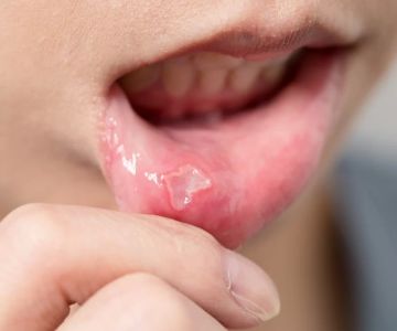 Effective Ways on How to Heal Mouth Ulcers Quickly and Safely