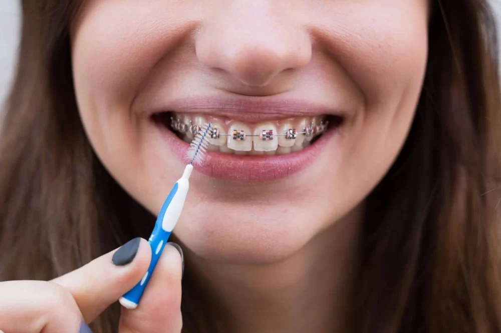 Effective Ways to Clean Braces to Avoid Gum Problems and Maintain Oral Health