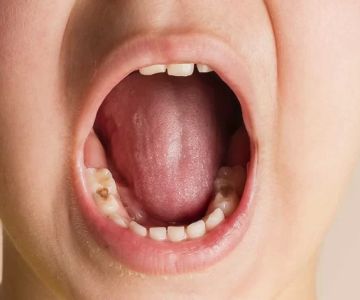 How to Prevent Tooth Decay with Sugar Substitutes: Effective Strategies and Insights