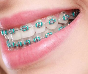 Best Dental Care Routine for Braces to Keep Your Smile Healthy and Bright