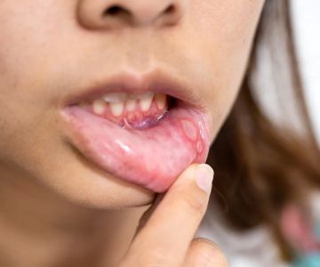Understanding Signs of Oral Thrush Infection Symptoms for Early Detection and Care