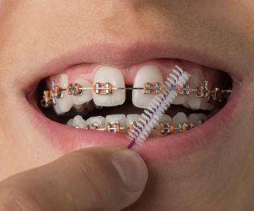 How to Clean Dental Braces Effectively for a Healthy Smile