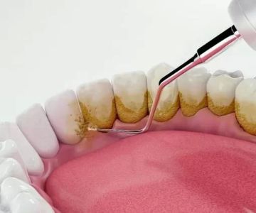Natural and Effective Ways to Reduce Plaque for Healthier Teeth